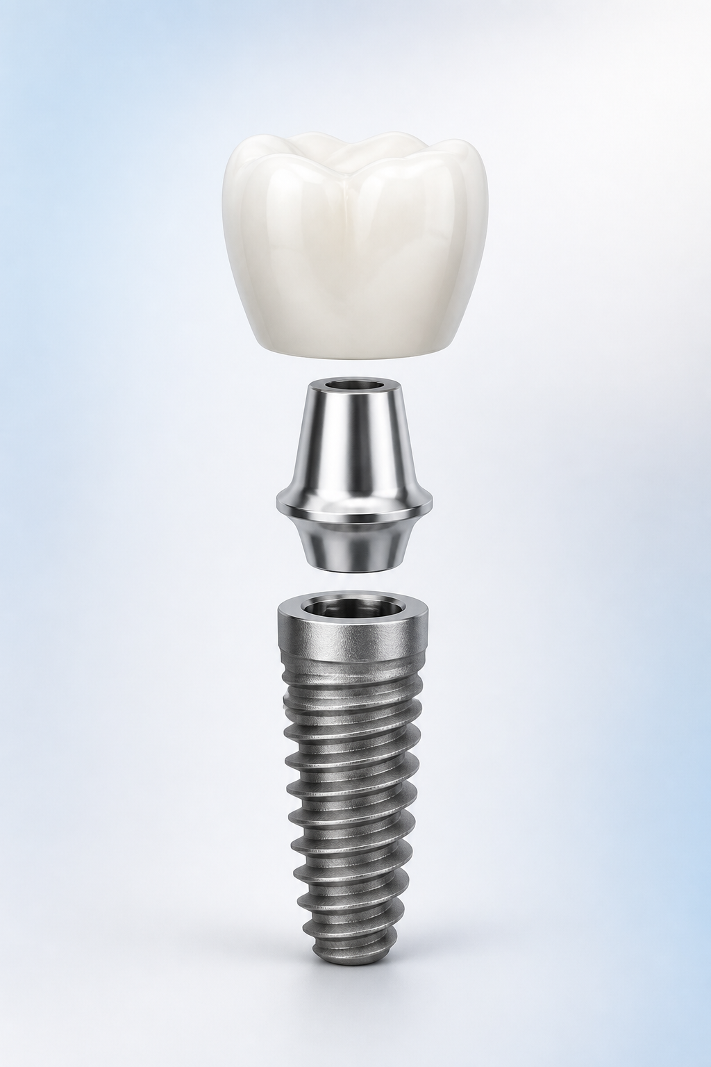 Ilustrim i implantit dentar — kurora, abutmenti dhe vida